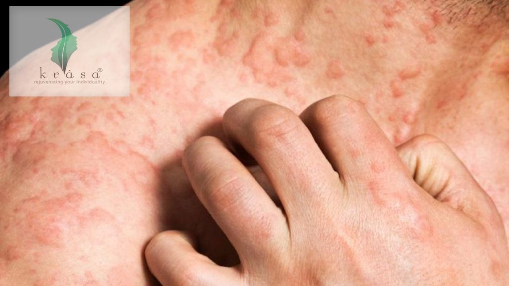 Eczema: Definition, Symptoms, Causes &  Treatments