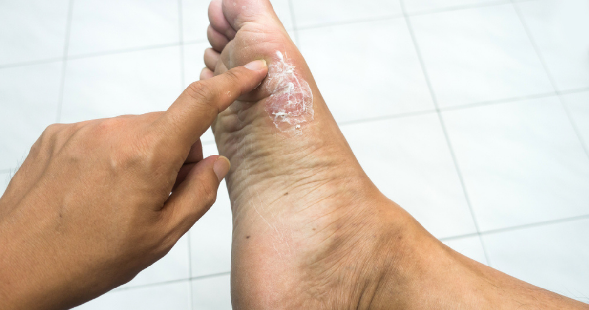 athlete-s-foot-or-eczema-eczemainfoclub