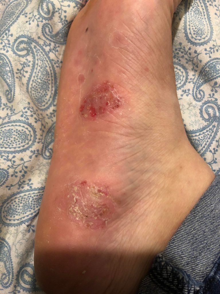 Gotta Love The Dishydrotic Eczema On My Foot Only Ever 768x1024 