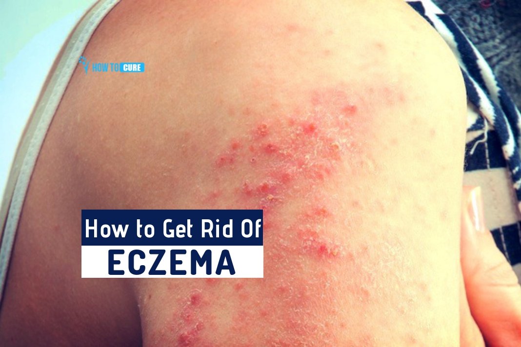 How To Get Rid Of Eczema With 6 Best Natural Remedies