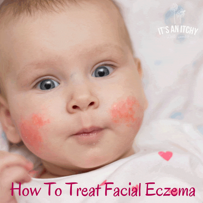 How To Treat Facial Eczema