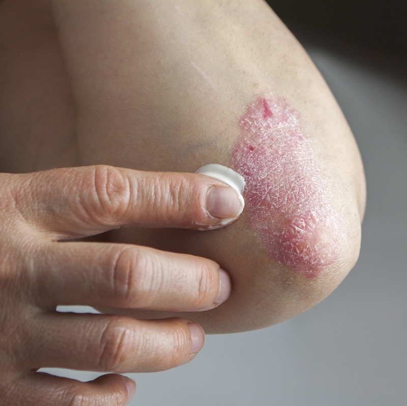 People With Eczema Are Itching For Better Health Care : Shots