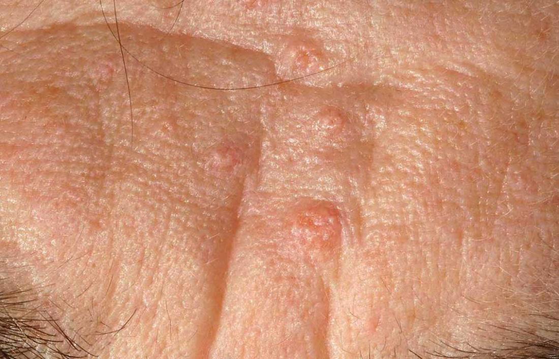 Sebaceous hyperplasia: Causes, symptoms, and removal