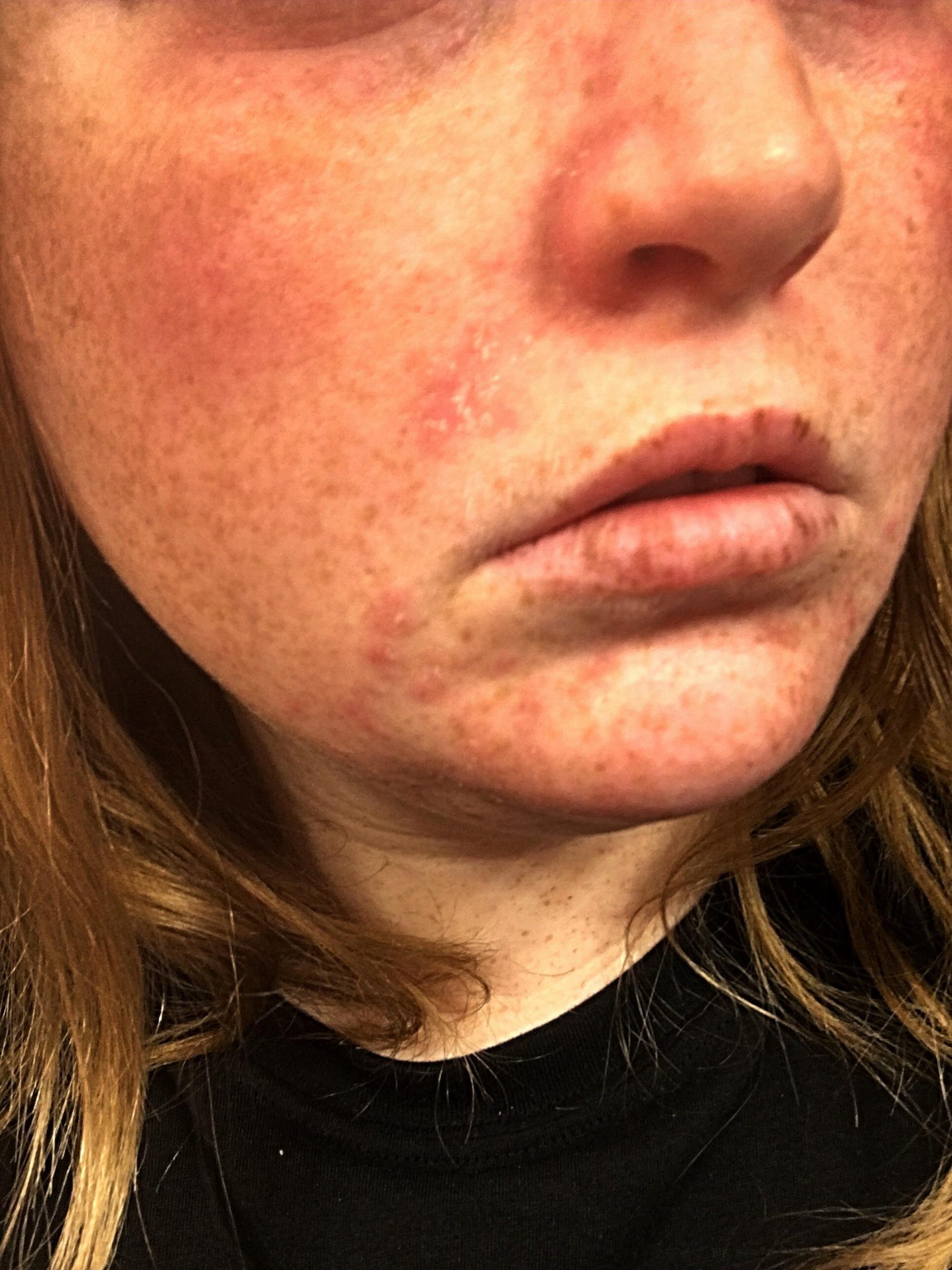 [Skin Concerns] Eczema on my face, please help! Routine in ...