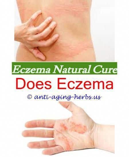 When many people think of eczema, they think of some skin condition ...